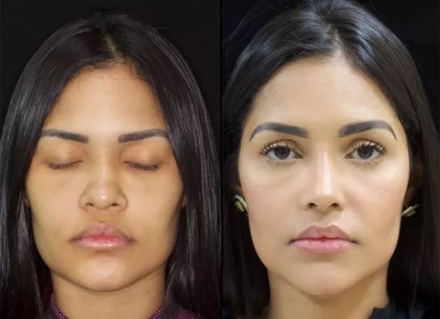 Rinoplastia ou rinomodela&ccedil;&atilde;o: entenda a diferen&ccedil;a!